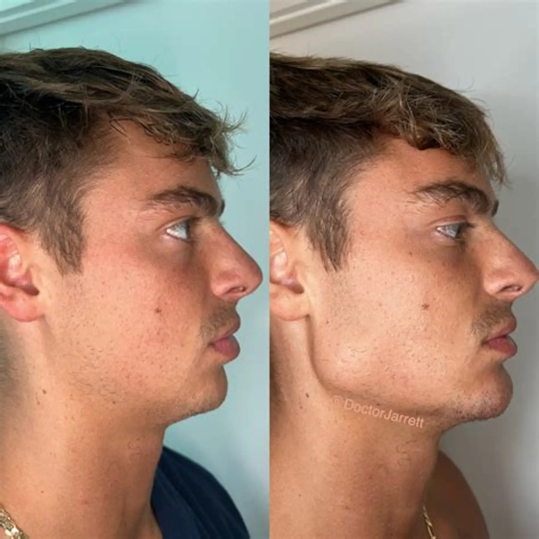 Jawline Contour