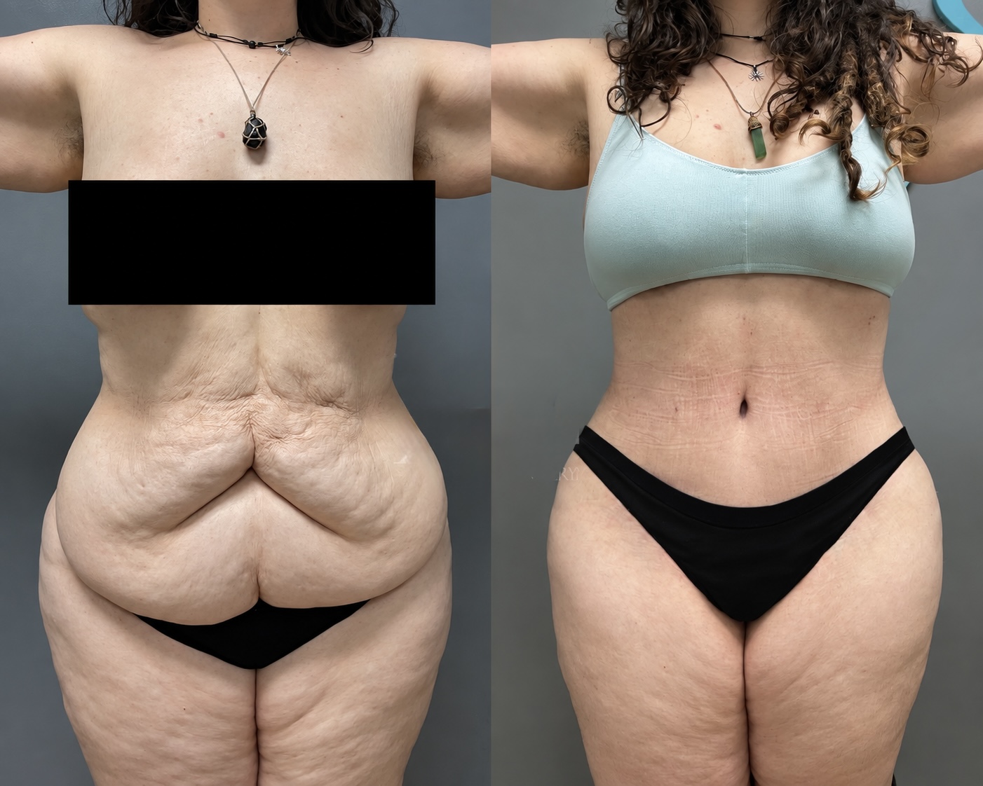 Liposuction